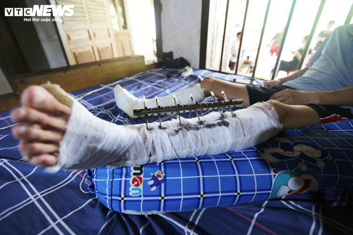 Anh Kiên nằm một chỗ sau khi đôi chân bị máy cắt tàn phá. Bác sĩ nói cần rất nhiều tiền để có thể đi lại bình thường. (Ảnh: Trọng Tùng)
