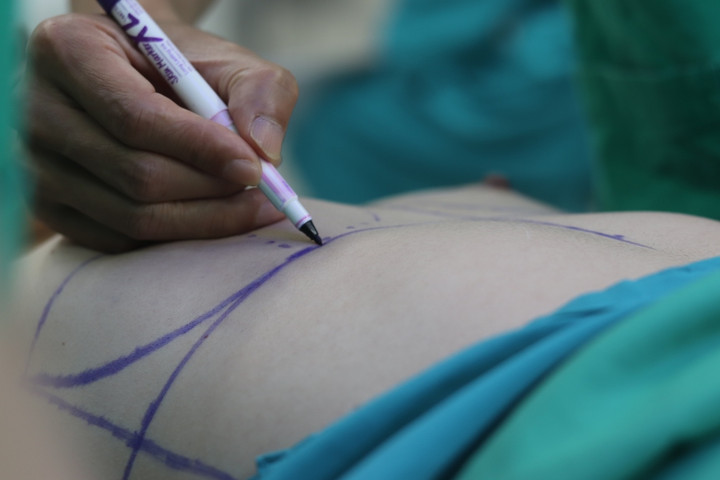 Nâng ngực bị sẹo, nguyên nhân do đâu? - 3