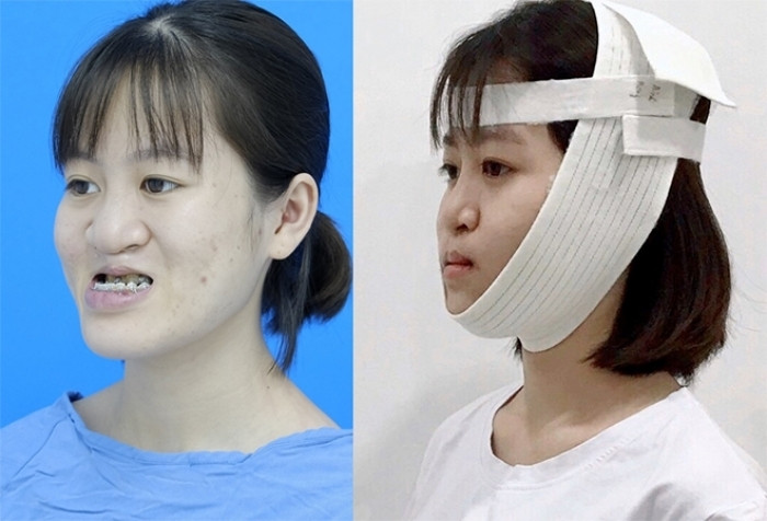 Từ lần phẫu thuật đầu tiên, gương mặt Bình có những cải thiện tích cực.