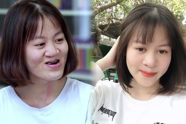 Trải qua ba cuộc phẫu thuật, gương mặt Bình thay đổi đến bất ngờ.