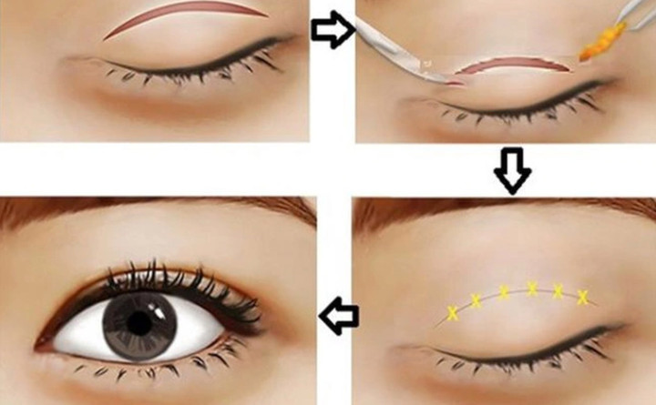 Cắt mắt 2 mí là phương pháp tiểu phẫu phổ biến hiện nay.