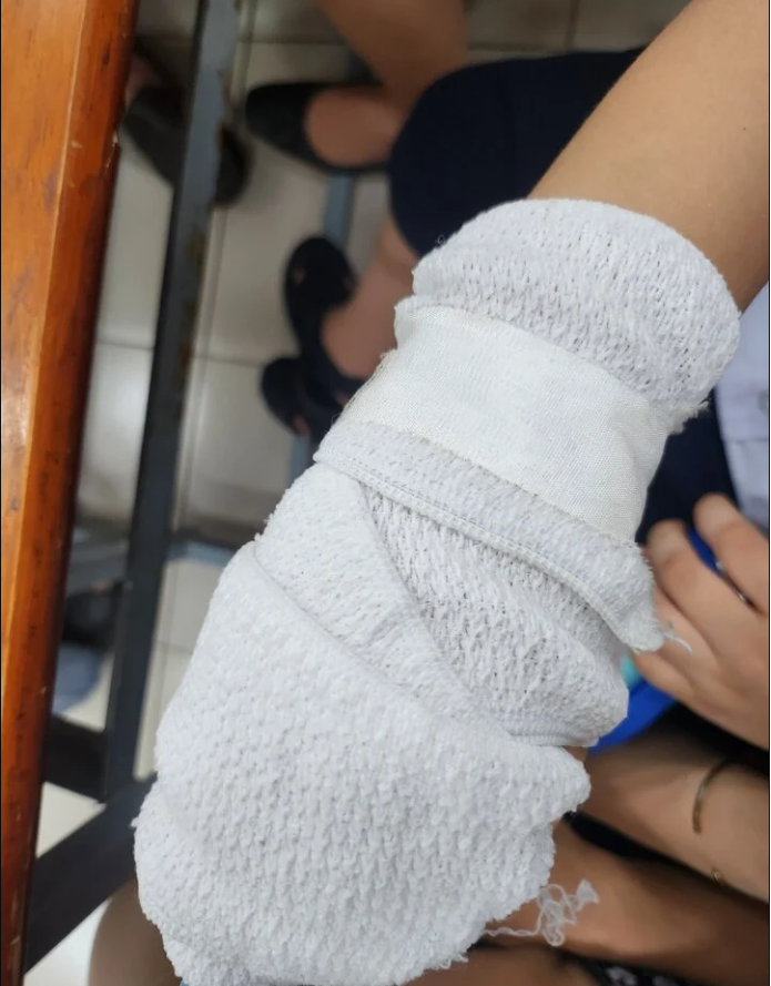 Tay của học sinh M.K. (Ảnh: PHCC).