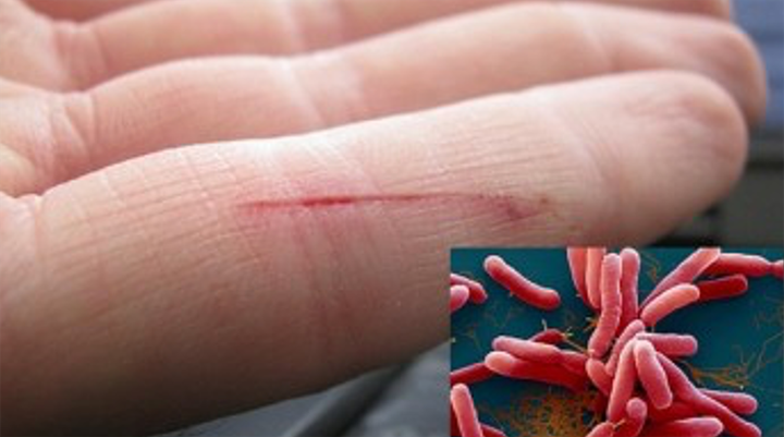 Sở Y tế Quảng Nam chỉ đạo tăng cường công tác chẩn đoán và điều trị bệnh Whitmore sau khi địa phương này ghi nhận ca tử vong. (Ảnh minh họa)