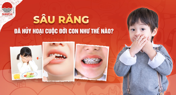 Sâu răng ở trẻ gây nhiều tác hại nguy hiểm hơn cha mẹ nghĩ - 1