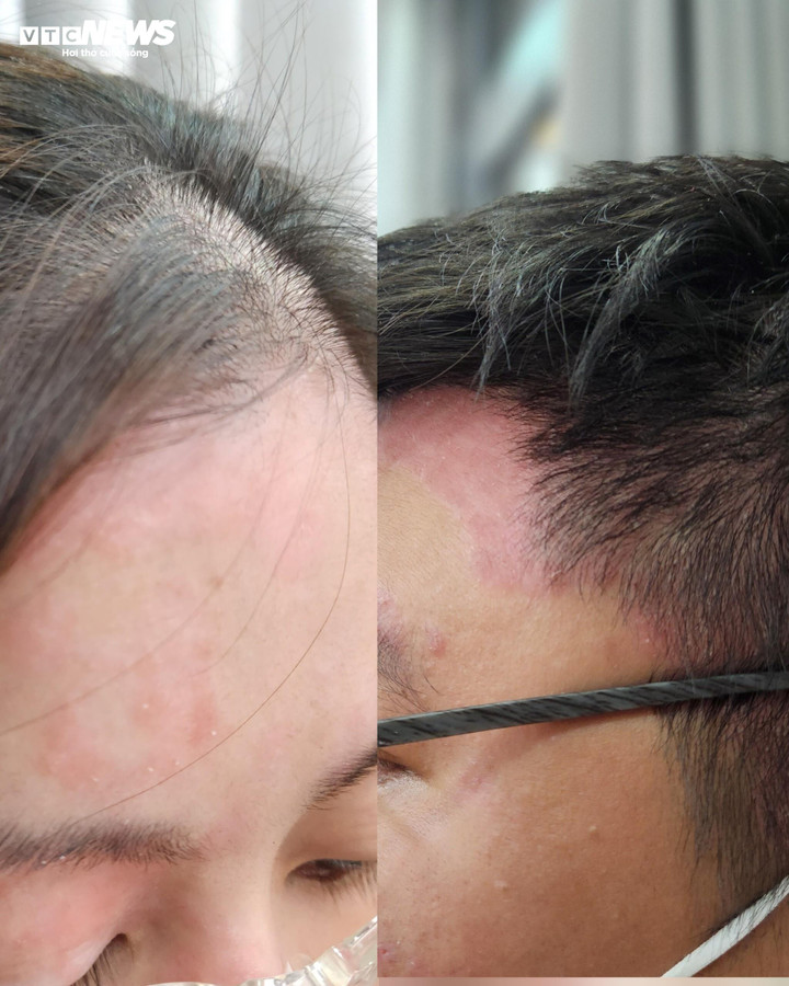 Vị trí tổn thương khi mắc bệnh vảy nến có màu hồng hoặc đỏ, thậm chí màu tím hoặc nâu sẫm; riêng vảy có thể màu trắng, bạc hoặc xám.