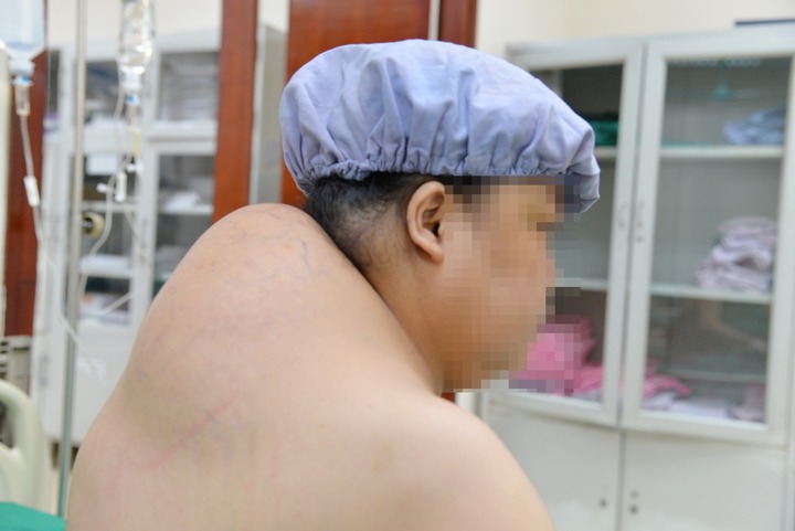 U mỡ trên gáy bà H. xuất hiện cách đây 10 năm, 3 năm nay khối u phát triển nhanh.