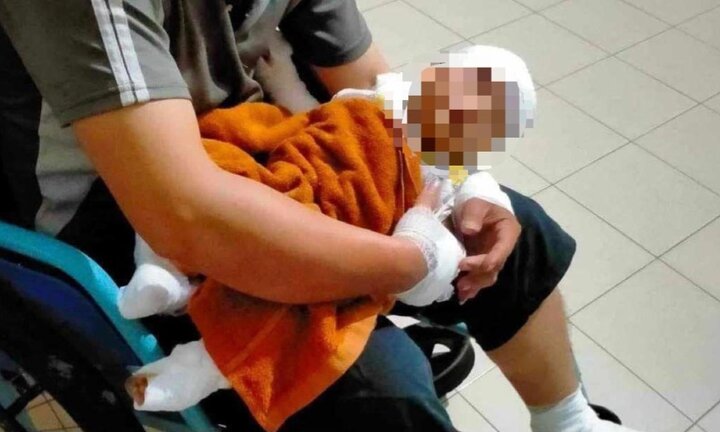 Cháu A. bị phỏng nặng đang điều trị tại Bệnh viện Đa khoa tỉnh Bình Thuận (Ảnh: V.T)