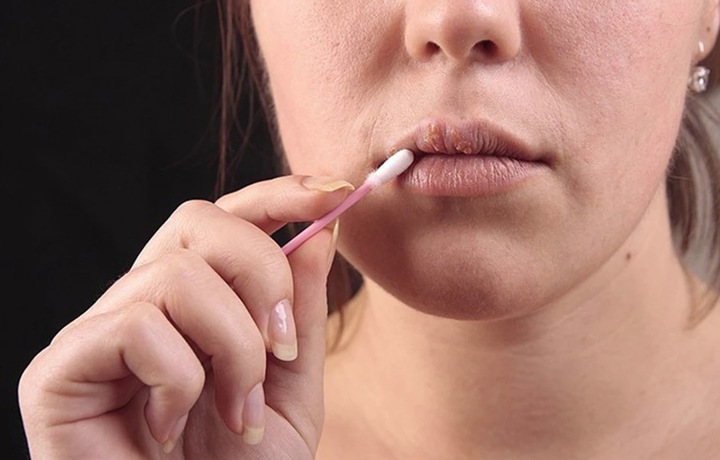 Môi khô nứt nẻ khiến gương mặt các chị em trở nên thiếu sức sống.