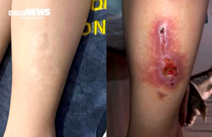 Chân của A. trước và sau khi điều trị sẹo tại Phòng khám Quốc tế Sài Gòn.