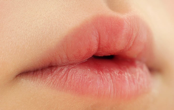 Sưng môi có thể do dị ứng các loại thực phẩm, thuốc, dị ứng cơ địa,...