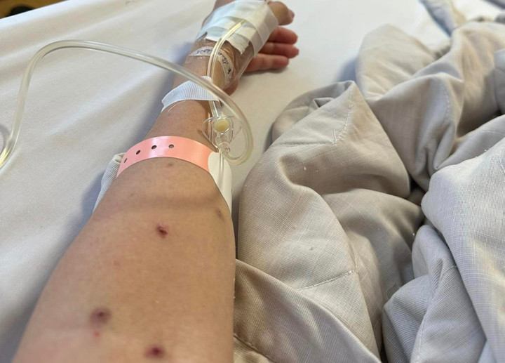 Cánh tay chị Mai với nhiều vết bầm sau xét nghiệm sốt xuất huyết. (Ảnh: NVCC)