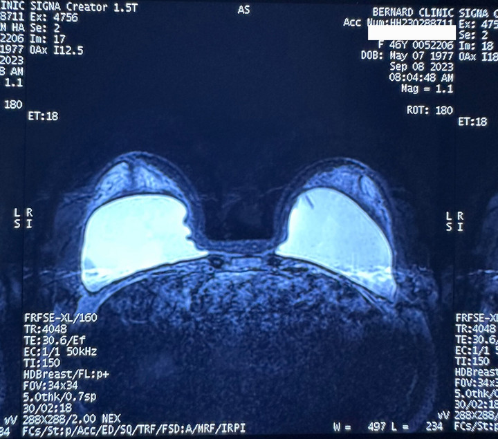Hình ảnh chụp MRI túi ngực bị gấp do khoang hẹp. (Ảnh:Ths.Bs Hồ Cao Vũ)