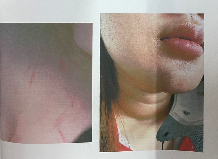 Nữ sinh T.H bị nhóm phụ huynh đánh hội đồng tại nơi sinh sống. (Ảnh: B.L)