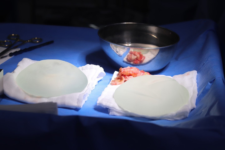 Túi ngực và bao xơ được lấy ra sau phẫu thuật. (Ảnh: Ths.Bs Hồ Cao Vũ)