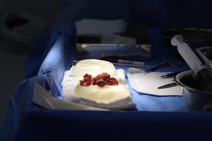 Túi ngực và bao xơ được lấy ra sau phẫu thuật. (Ảnh: Ths.Bs Hồ Cao Vũ)