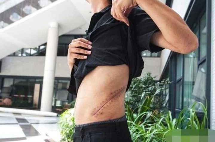 Vết mổ thận của Vương Thượng Côn