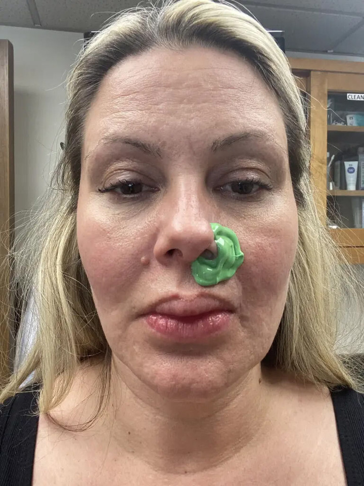 Không có tiền tái tạo lại mũi, Carson phải lắp lỗ mũi giả.