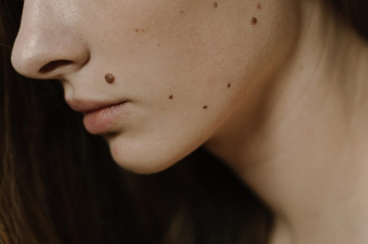 Nốt ruồi có nhiều kích cỡ, hình dạng và màu sắc khác nhau.