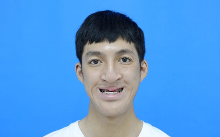 Khuôn mặt Quang trước khi phẫu thuật.