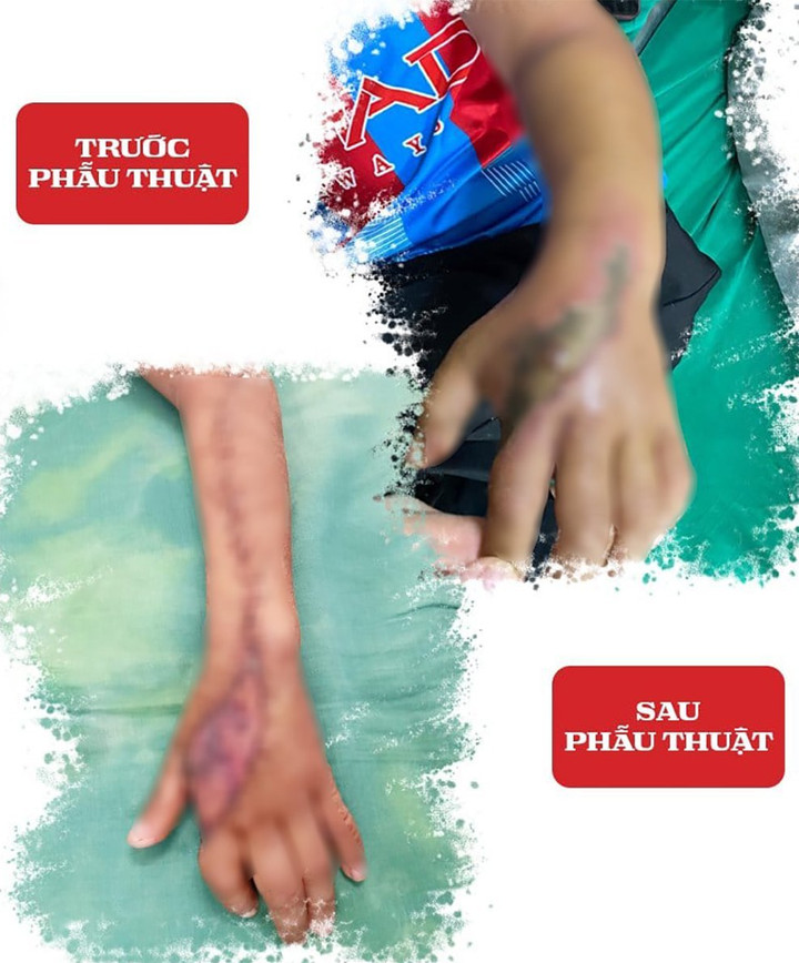 Vết thương hiện đã bám tốt, hồng, vết mổ khâu da vùng cẳng tay khô, liền mép.