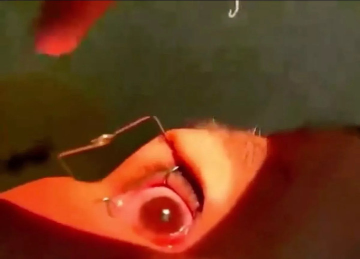 Các bác sĩ gắp hơn 60 con giun còn sống khỏi mắt nữ bệnh nhân.