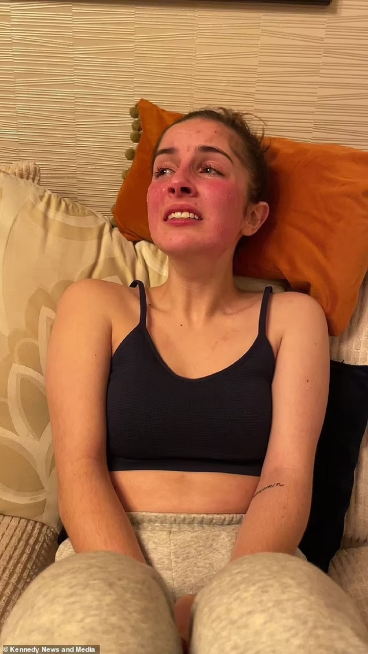 Cô có làn da phản ứng với mọi thứ nên luôn bị đau đớn. (Ảnh: Daily Mail)