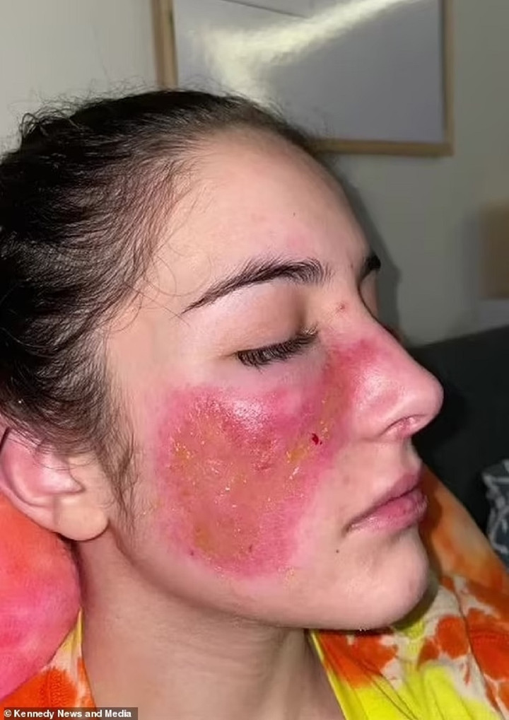 Làn da bị chảy mủ, bong tróc của Bent. (Ảnh: Daily Mail)