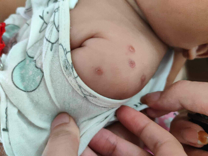 Cơ thể bé trai xuất hiện mụn nước to, ngứa ngáy.