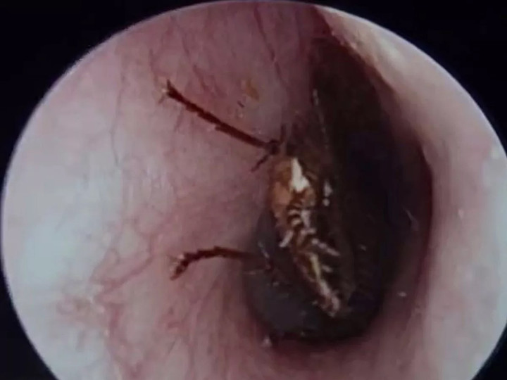 Khi trẻ bị gián bò vào tai, cha mẹ nên nhỏ chút dầu ăn hoặc dầu massage vào tai trẻ để gián chết ngạt, không làm tổn thương màng nhĩ của con. (Ảnh: minh họa)