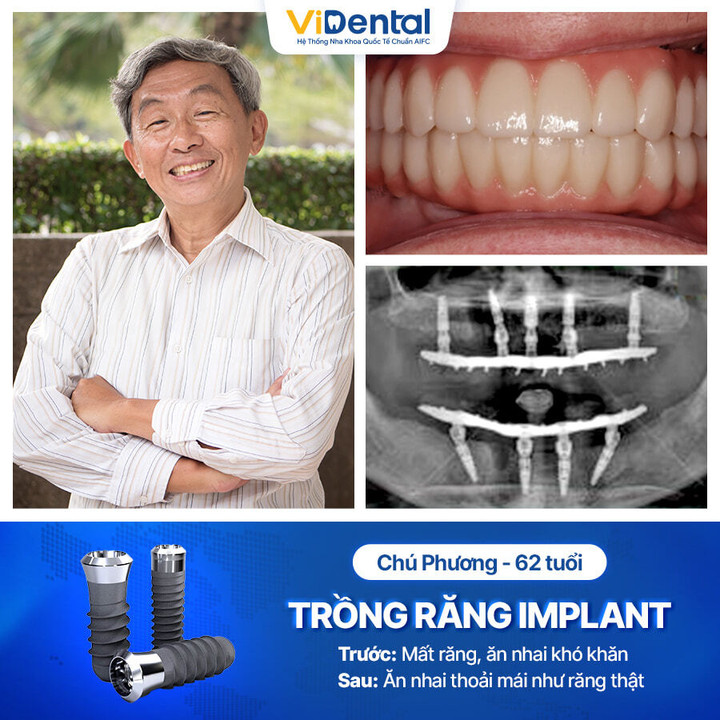 Nha khoa ViDental - Địa chỉ trồng răng Implant không đau trọn gói - 5