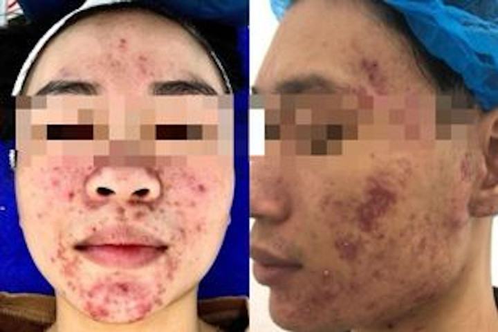 Da của Minh (bên phải) và Mai xuất hiện các ô viêm nhiễm, đầy dịch mủ sau khi sử dụng mỹ phẩm không rõ nguồn gốc. (Ảnh BSCC)