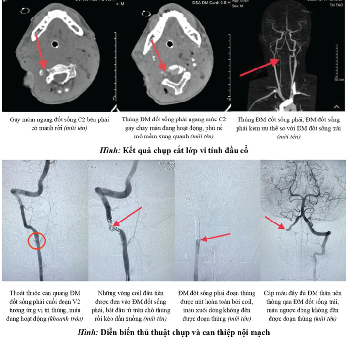 Ảnh chụp cắt lớp vi tính đầu cổ khu vực bị tổn thương và quá trình can thiệp nội mạch. (Ảnh: BVCC)