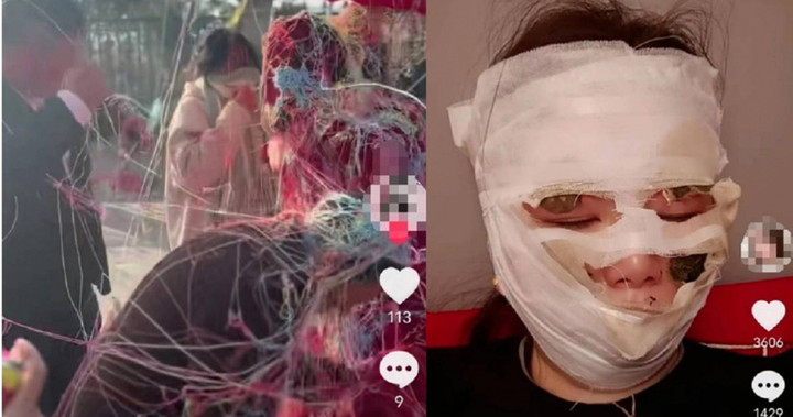 Sau sự cố bình xịt quy băng bốc lửa trong đám cưới, cô dâu phải băng bó vùng mặt như xác ướp. (Ảnh: Douyin)