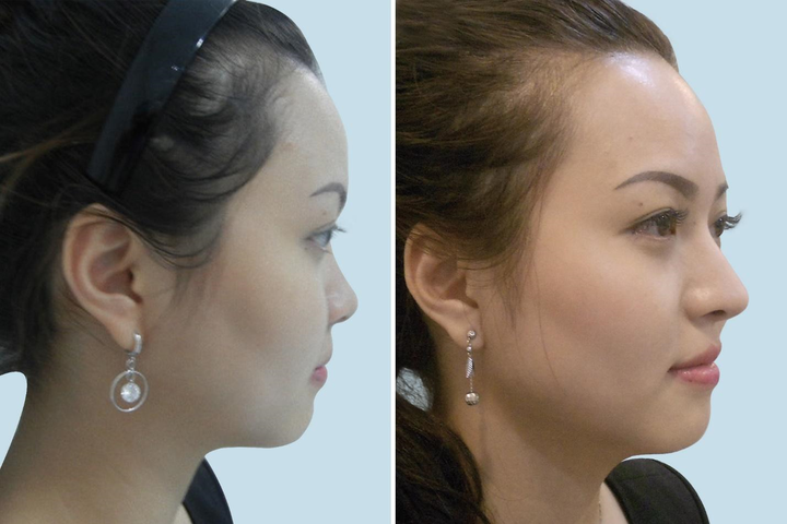 Chất làm đầy chỉ có tác dụng cải thiện chiều cao của mũi nhưng không cải thiện được chiều dài mũi.