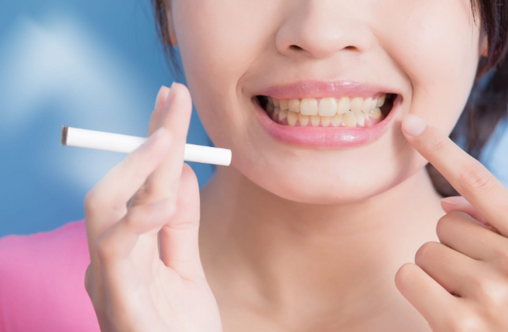 Hút thuốc lá là thói quen khiến răng bị ố vàng. (Ảnh: Southfloridadentalcare)