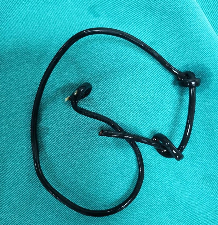 Đoạn đây được nam thiếu niên đút qua đường niệu đạo. (Ảnh: BVCC)