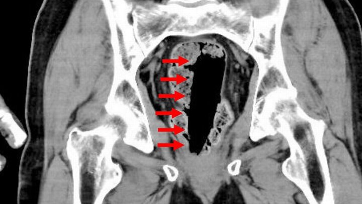 Kết trái ngược chụp CT đã cho chúng ta biết một vỏ hộp keo dán ở phía vô lỗ đít người bệnh dịch. (Ảnh: Jam Press)
