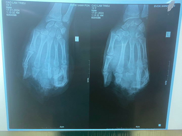 Hình ảnh phim chụp của bệnh nhân. (Ảnh: BVCC)
