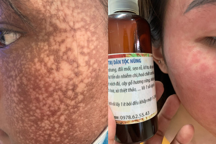 Bôi thuốc mua trên mạng, mặt chị Hoa sạm đen do biến chứng. (Ảnh: BSCC)