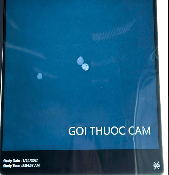 Hình ảnh phim chụp X-Quang cản quang của thuốc cam do gia đình cho trẻ uống. (Ảnh: BVCC)