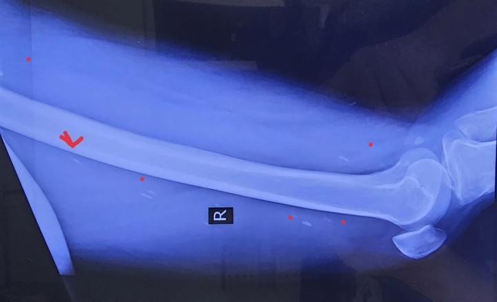 Trên phim chụp, bác sĩ thấy người đàn ông nhiễm nhiều loại giun sán, đặc biệt là sán dây, ở cả não và trong cơ. (Ảnh: BSCC)