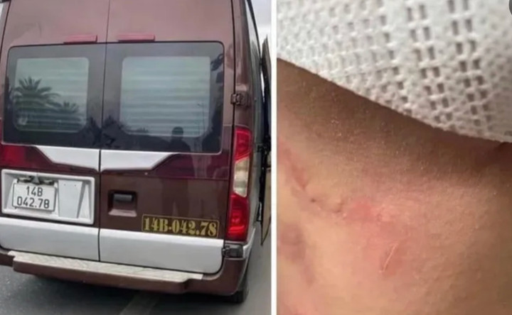 Xe khách trong vụ việc và vết thương ở cổ hành khách được chia sẻ trên mạng xã hội.