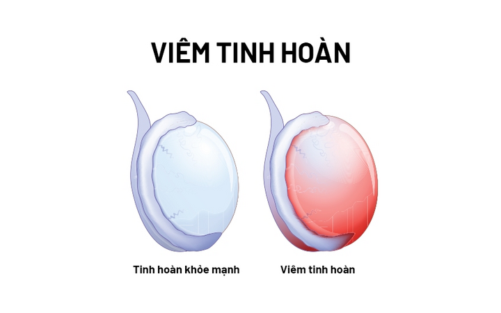 Viêm tinh hoàn thường gặp ở nam giới trưởng thành, cần được điều trị đúng cách để không gây biến chứng nguy hiểm.