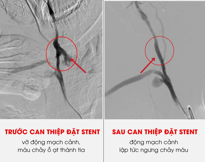 Hình ảnh trước và sau khi đặt stent vá lỗ thủng động mạch giúp cầm máu cho bệnh nhân.