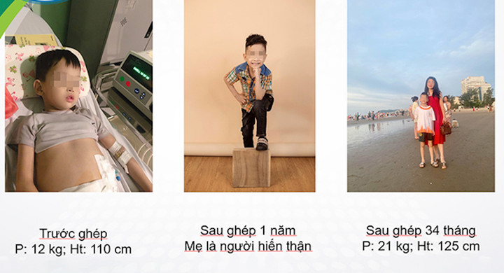 Bé trai 6 tuổi suy thận được phẫu thuật đã có cuộc sống khoẻ mạnh. (Ảnh: BVCC)