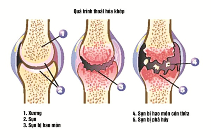 Bác sĩ Trần Minh đồng hành chia sẻ và chăm sóc bệnh nhân thoái hóa khớp - 2