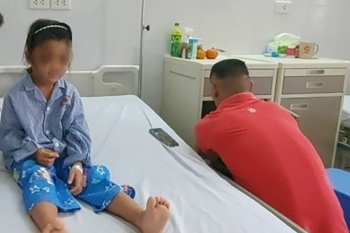 Mắt cháu L. bị thâm tím sau khi cô giáo dùng thước kẻ gõ vào đầu. (Ảnh: V.M)