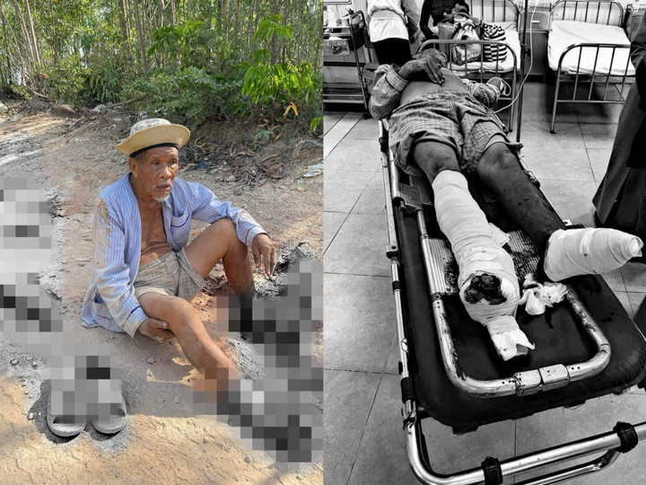 Hình ảnh cụ ông 85 tuổi bị xe ben cán nát 2 chân rồi bỏ chạy. (Ảnh: Người dân và bệnh viện cung cấp)