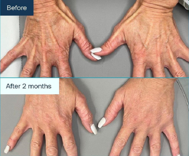 Hiệu quả tái tạo bàn tay búp măng cho chị em của Radiesse. (Nguồn ảnh: Merz Aesthetics VN)