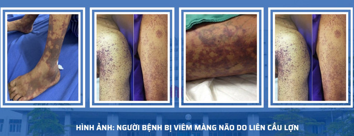 Viêm màng não vì sở thích ăn nem chua, thịt lợn tái - 1